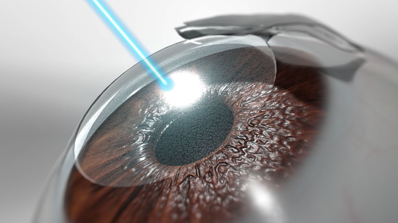 Can You Do Lasik Surgery More Than Once