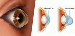 c3r keratoconus