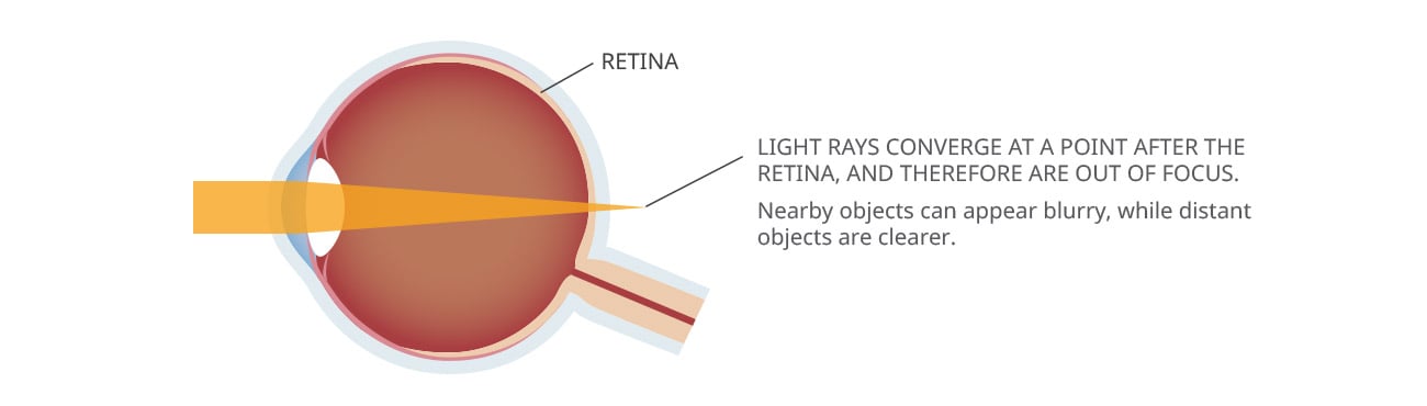 Can Lasik Cure Hyperopia? - Visual Aids Centre