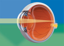 does laser eye surgery correct long and short sightedness