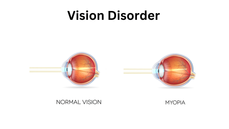 Close-up of an eye being examined for myopia after LASIK surgery.