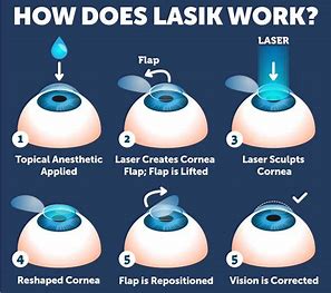 Image explaining reasons for fluctuating vision after LASIK surgery.