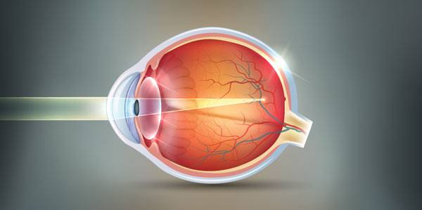 Illustration of LASIK surgery with a focus on treating mild myopia.