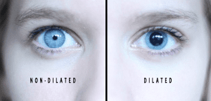 Eyes dilated after LASIK surgery, showing the effects on vision.