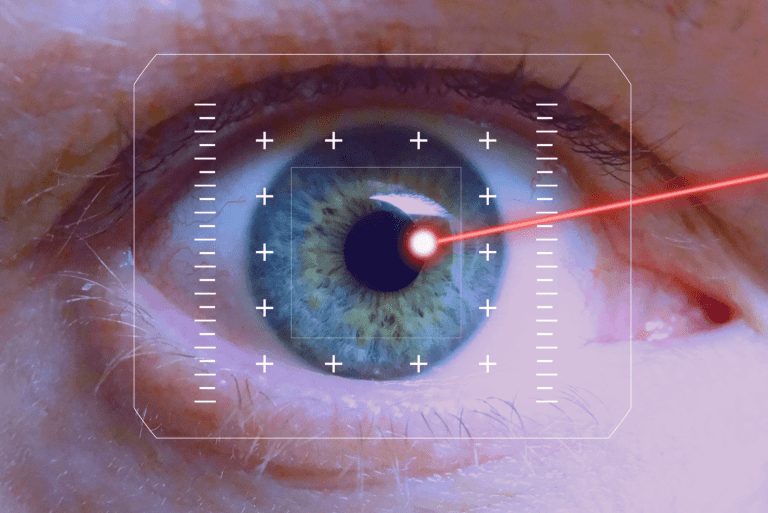 Diagram showing the corneal flap created during LASIK surgery.