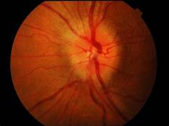 Can optic neuritis patient undergo lasik?