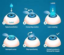 Can lasik cure a negative eye number?