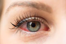 Can We Use Anti Fungal Tablets After Lasik Surgery?