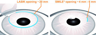 LASIK vs LASEK vs SMILE