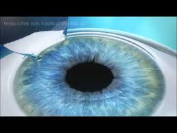 What Is Femto Lasik?