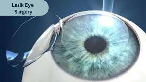 Can lasik be detected after 5 years?