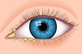 How to clean eye boogers after lasik?