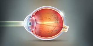 Can LASIK Cure Myopia Permanently