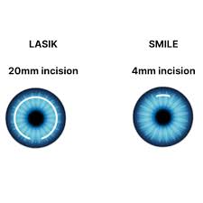 Is Smile Pro Eye Surgery More Suitable For Athletes Than LASIK?