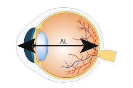 Does Lasik Reduce Axial Length Of Eye