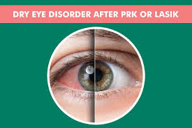 How Common Is Dry Eye Syndrome After LASIK?