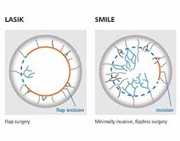 What are the key differences between Wavelight Plus InnovEyes and LASIK?