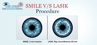 Is Smile Better Than Lasik?