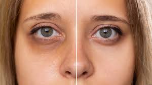 How To Remove Dark Circles After Lasik?