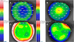 Corneal Topography For Lasik