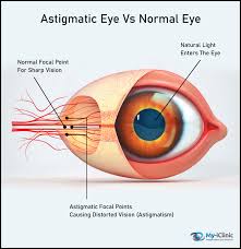 Best Eye Surgery For Astigmatism