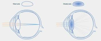 LASIK Vs Lens Replacement Cost