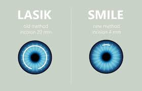 Smile Pro Eye Surgery Vs. Contact Lens