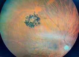 Can You Do LASIK If You Have Retinal Holes?