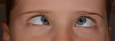 Can Lasik Reduce Squint