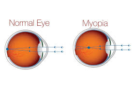 Can Lasik Fix Short Sightedness