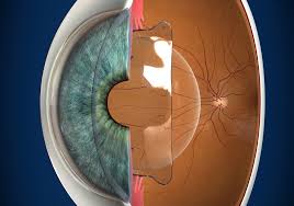 What Is The Minimum Keratometry For Lasik Eye Surgery?