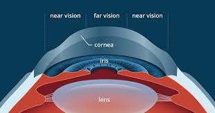 What Is Hyperopic Lasik Limits?