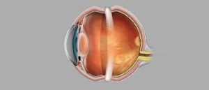 Can I Get Lasik If I Have A Scleral Buckle?