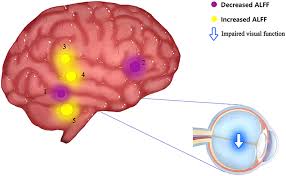 Lasik & Visual Cortex: How The Brain Adapts To Refractive Surgery?