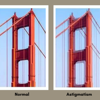 Astigmatism